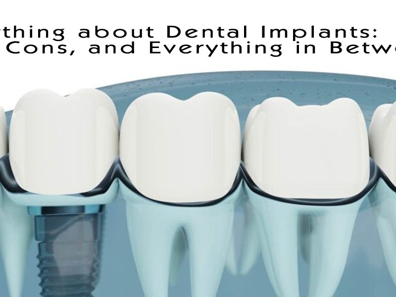 Dental implants: pros, cons, and everything you need to&nbsp;know